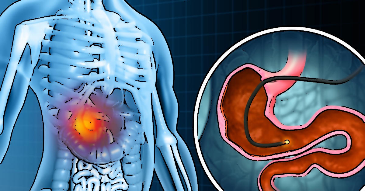 Helicobacter Pylori Enfeksiyonu: Belirtileri ve Tedavi Yöntemleri